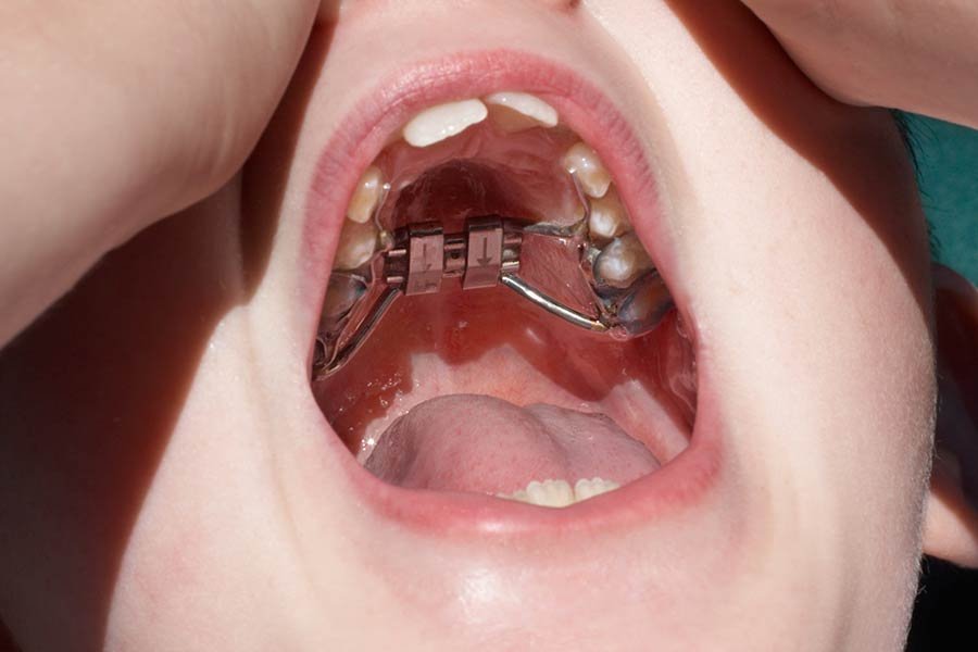 Palatal Expander Ottawa ON Centrepointe Orthodontics